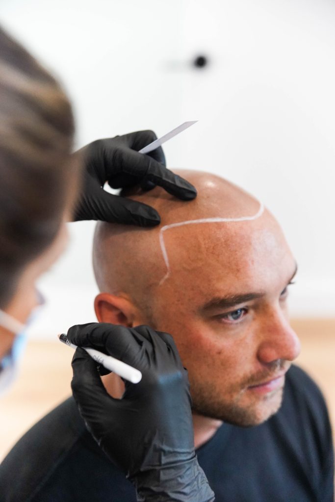 scalp-micro-pigmentation-australia-hair-loss-treatment-melbourne-sydney-brisbane-bondi-adelaide-treatment-gym-tattoo-receding-best