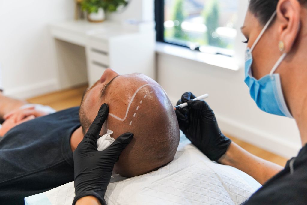 scalp-micro-pigmentation-best-natural-micropigmentation-smp-adelaide-sydney-melbourne-geelong-brisbane-australia-experience-hairloss-treatment-experienced